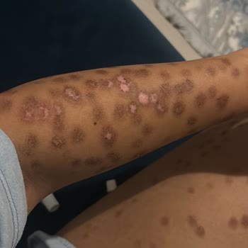 Lazer Epilasyon Sonrası Ciddi Yanıklar Ve Klinikten İlgisizlik