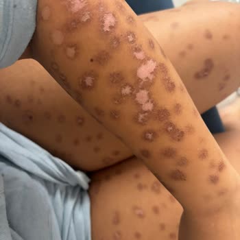 Lazer Epilasyon Sonrası Ciddi Yanıklar Ve Klinikten İlgisizlik