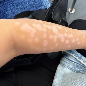 Lazer Epilasyon Sonrası Ciddi Yanıklar Ve Klinikten İlgisizlik