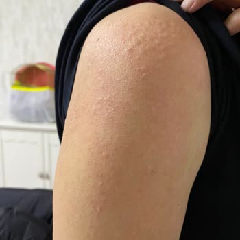 Lazer Epilasyon Sonrası Mağduriyet Ve İlgisiz Personel