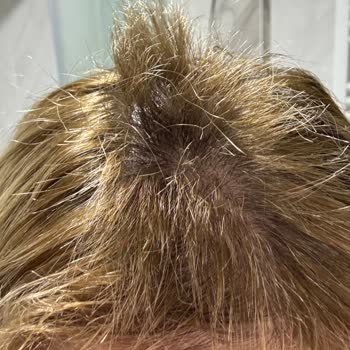 Alper Bayan Kuaförü |Sivas İşlem Sonrası Saçlarım Yandı, Koptu Ve Aşırı Derecede Yıprandı!