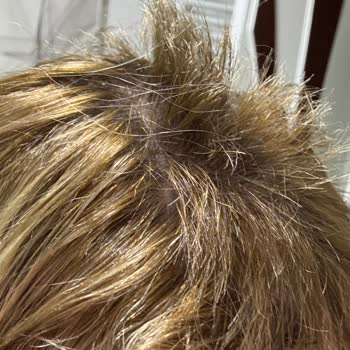 Alper Bayan Kuaförü |Sivas İşlem Sonrası Saçlarım Yandı, Koptu Ve Aşırı Derecede Yıprandı!