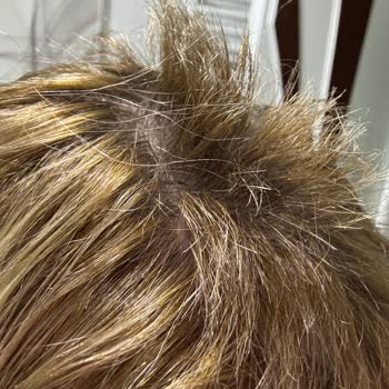 Alper Bayan Kuaförü |Sivas İşlem Sonrası Saçlarım Yandı, Koptu Ve Aşırı Derecede Yıprandı!