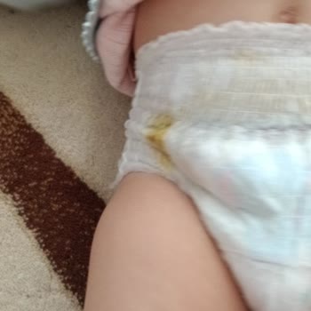 Molfix Bezlerde Sürekli Sızdırma Ve Kalite Düşüşü Bebeğimde Pişik Yaptı