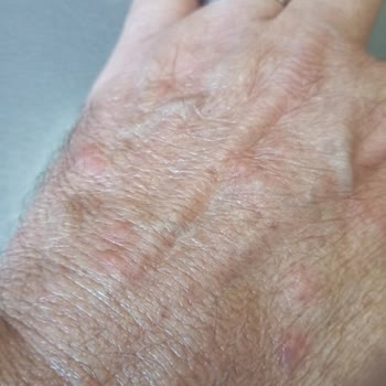 Venüs Otelde Konaklama Sonrası Vücudumda Yayılan Kızarıklıklar Ve Hijyen Endişesi
