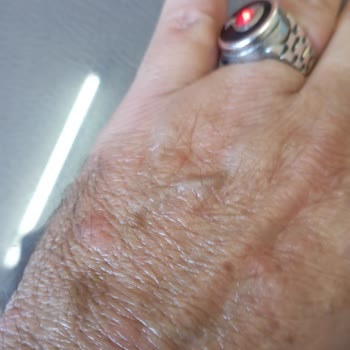 Venüs Otelde Konaklama Sonrası Vücudumda Yayılan Kızarıklıklar Ve Hijyen Endişesi