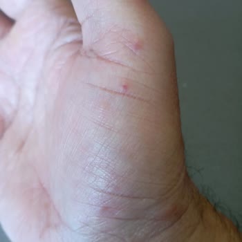 Venüs Otelde Konaklama Sonrası Vücudumda Yayılan Kızarıklıklar Ve Hijyen Endişesi