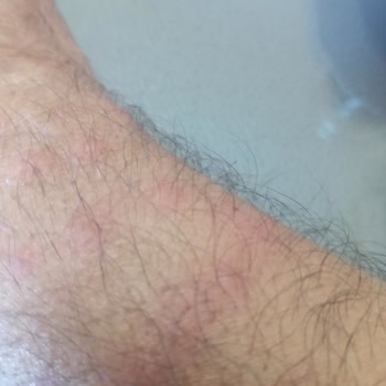 Venüs Otelde Konaklama Sonrası Vücudumda Yayılan Kızarıklıklar Ve Hijyen Endişesi