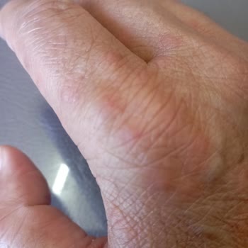 Venüs Otelde Konaklama Sonrası Vücudumda Yayılan Kızarıklıklar Ve Hijyen Endişesi