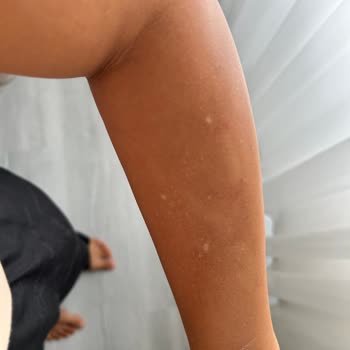 Lazer Epilasyon Sonrası Kalıcı Beyaz Lekeler Ve Acı Yaşadım Açıklama Bekliyorum