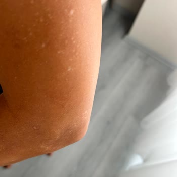 Lazer Epilasyon Sonrası Kalıcı Beyaz Lekeler Ve Acı Yaşadım Açıklama Bekliyorum