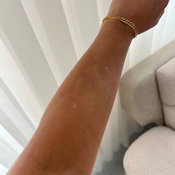 Lazer Epilasyon Sonrası Kalıcı Beyaz Lekeler Ve Acı Yaşadım Açıklama Bekliyorum