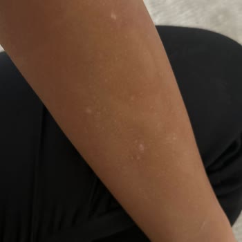 Lazer Epilasyon Sonrası Kalıcı Beyaz Lekeler Ve Acı Yaşadım Açıklama Bekliyorum