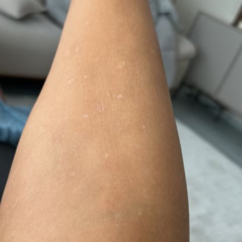 Lazer Epilasyon Sonrası Kalıcı Beyaz Lekeler Ve Acı Yaşadım Açıklama Bekliyorum