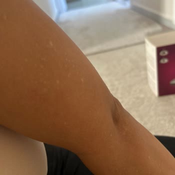 Lazer Epilasyon Sonrası Kalıcı Beyaz Lekeler Ve Acı Yaşadım Açıklama Bekliyorum