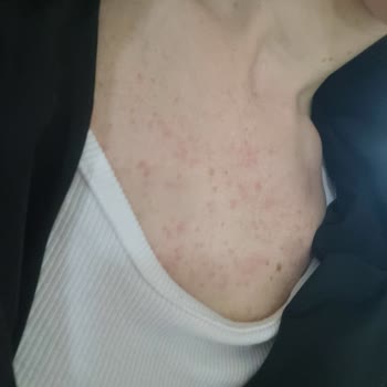 Bingo Lilyum Yumuşatıcı Ciddi Alerjik Reaksiyona Sebep Oldu, Sağlık Sorunları Yaşıyorum