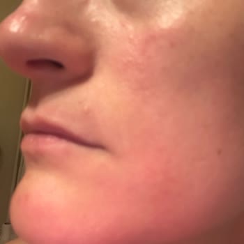 Anti AGE Global Serum Sonrası Cildimde Ciddi Reaksiyon Ve Sağlık Sorunu Yaşadım