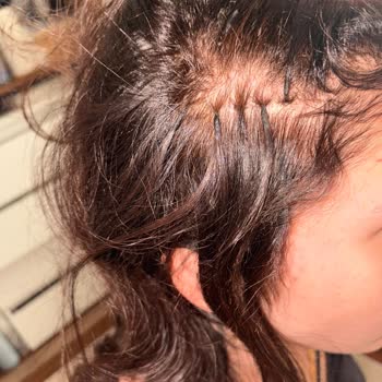 Saç Kaynak İşlemi Sonrası Yetersiz Saç Ve Ücret İadesi Sorunu