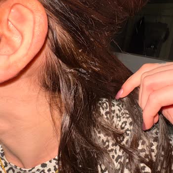 Saç Kaynak İşlemi Sonrası Yetersiz Saç Ve Ücret İadesi Sorunu