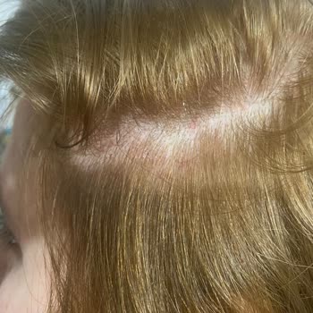 Saç Boyası Kullanımı Sonrası Sağlık Sorunları Ve Ücret İadesi Talebi