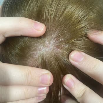 Saç Boyası Kullanımı Sonrası Sağlık Sorunları Ve Ücret İadesi Talebi