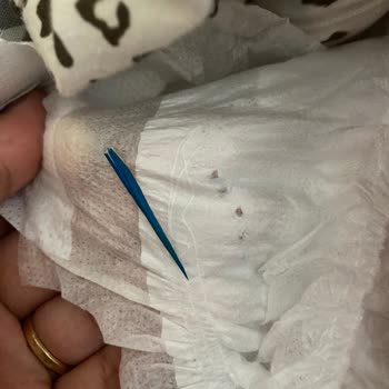 Bebek Bezinde Yabancı Cisim Tehlikesiyle Karşılaştım