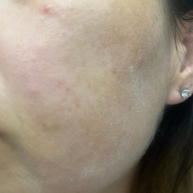 Frankly Ürünü Kullandığım İlk Günden Bu Yana Yüzümde Yoğun Kaşıntı Ve Sivilce Oluştu!