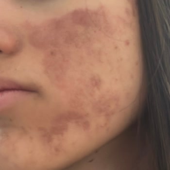 Yanlış Uygulama Sonrası Yüzümde Kalıcı Lekeler Oluştu