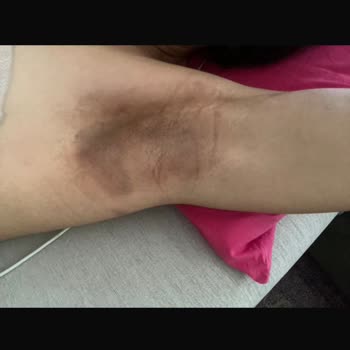 Koltuk Altı Beyazlatma Sonrası Kalıcı Yanık Ve İlgisizlik