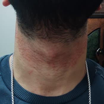 Burcu Uzun Güzellik Merkezi Lazer Epilasyon Sonrası Yanık Ve Yetersiz Hizmet Deneyimi