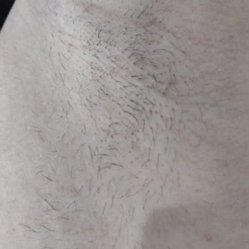 Burcu Uzun Güzellik Merkezi Lazer Epilasyon Sonrası Yanık Ve Yetersiz Hizmet Deneyimi