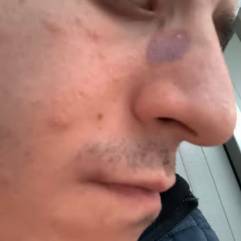 Vakumlu Siyah Nokta Temizleme Aleti Cildimde Tahriş Ve Morarmaya Sebep Oldu