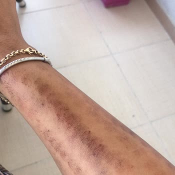 Zahide Düşmez Güzellik Merkezi Lazer Epilasyon Sonrası Yanık Ve İlgisizlik Nedeniyle Mağduriyet