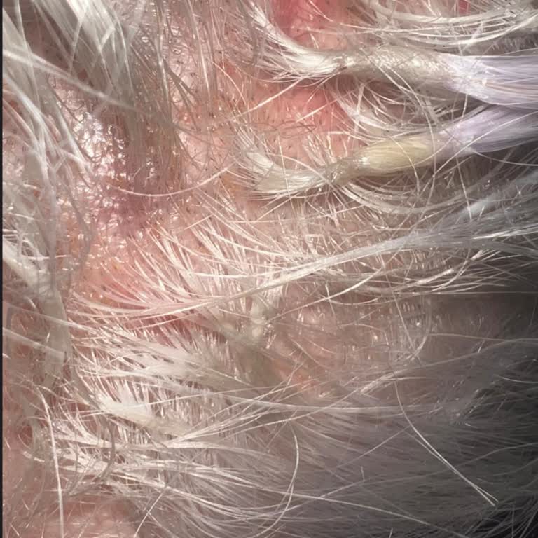 Berke Hair Extensions Saç Derimde Yanıklar