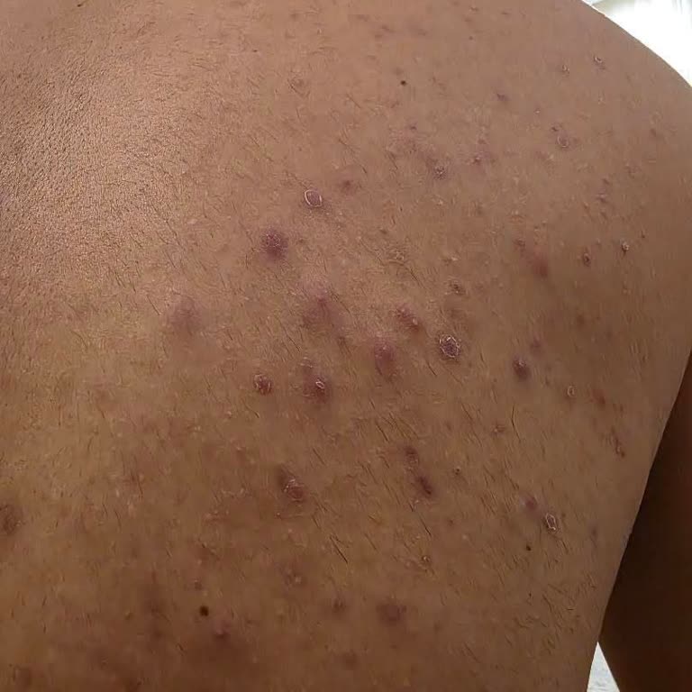 Epify Krem Sonrası Ciltte Ciddi Reaksiyon Ve Markanın Şeffaflık Eksikliği