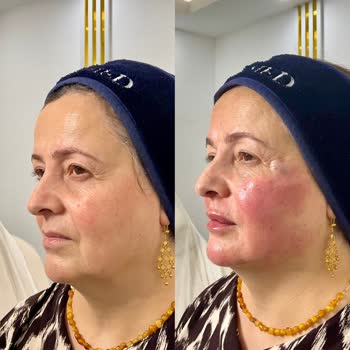 Linemed'de Yapılan İşlemler Sonrası Cilt Sorunları Ve Mağduriyet