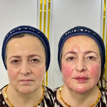 Linemed'de Yapılan İşlemler Sonrası Cilt Sorunları Ve Mağduriyet