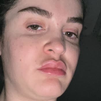 Linemed'de Yapılan İşlemler Sonrası Cilt Sorunları Ve Mağduriyet