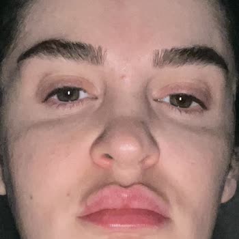 Linemed'de Yapılan İşlemler Sonrası Cilt Sorunları Ve Mağduriyet