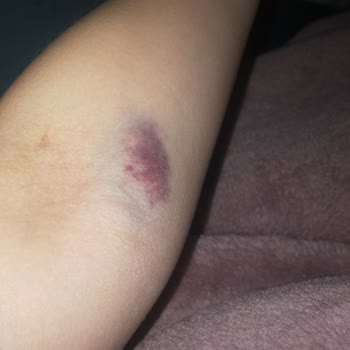 Acil Serviste Hemşirenin Hatalı Uygulaması Ve Saygısız Davranışı Sonucu Mağduriyet