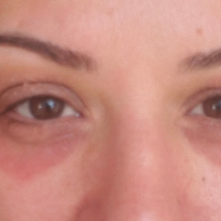 Krem Sonrası Göz Altımda Kalıcı Kızarıklık Ve Şişlik Oluştu