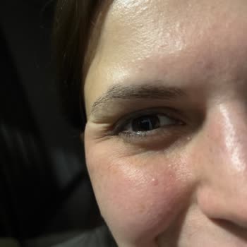 L'Loreal Paris Yaş Uzmanı Krem Cildimde Alerji Ve Şişlik Yaptı!