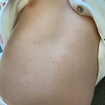 Bebek Bezi Alerji Yaptı, Acil Çözüm Bekliyorum