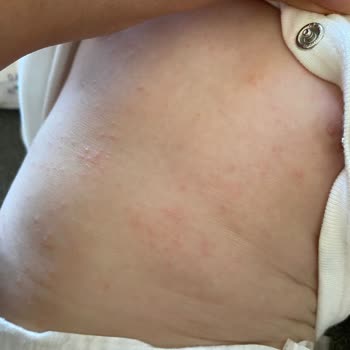 Bebek Bezi Alerji Yaptı, Acil Çözüm Bekliyorum