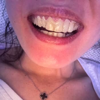 Dişlerim İstemeden Kesildi Ve Kliniğin Hatasını Kabul Etmemesi Beni Mağdur Etti