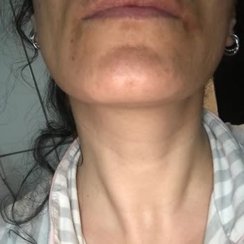 Orva İlaç Sanayi Expigment %4 Krem Sorunu