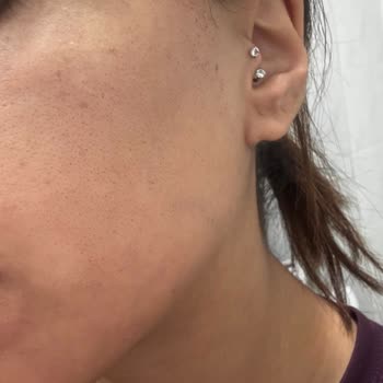 Lazer Epilasyon Sonrası Cildimde Kalıcı İzler Ve Mağduriyet Yaşadım