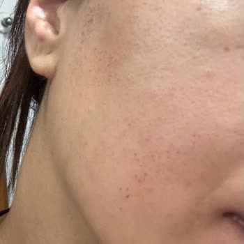 Lazer Epilasyon Sonrası Cildimde Kalıcı İzler Ve Mağduriyet Yaşadım