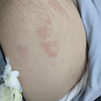 WC Açıcı Kullandım Kimyasal Yanıklar Ve Ciddi Maddi Zararlar Yaşadım