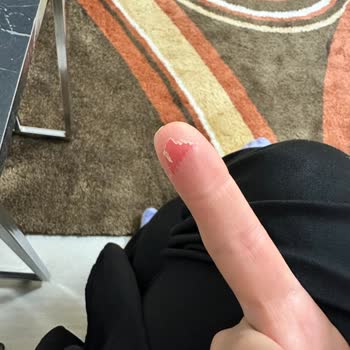 Arızalı Bant Makinesi Mağazada Parmağımı Kesti Çözüm Sunulmadı